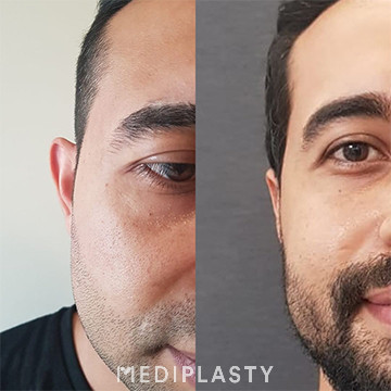 Ear Aesthetics (Otoplasty)