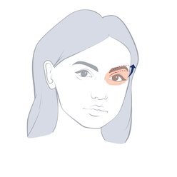 Eyebrow Lift