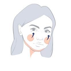 Face and Neck Lifting (Rhytidectomy)