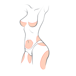 Liposuction