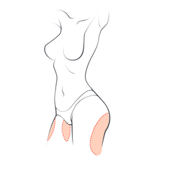 Thigh (Legs) Lifting