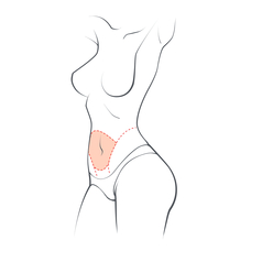 Tummy Tuck